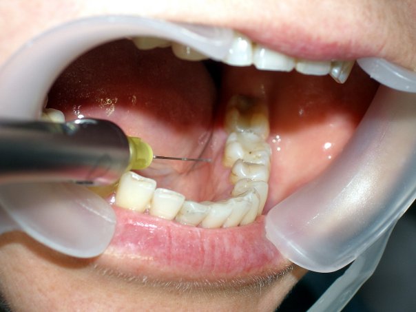 拔牙时常用的麻醉方法有哪些